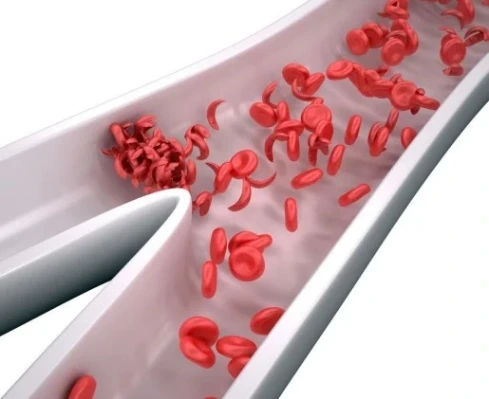 महाराष्ट्र में Sickle Cell रोग के मामलों में बढ़ोतरी